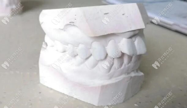 門牙有點凸嘴，牙齒不齊