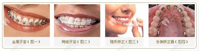 不同的矯正器對比