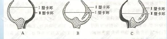 混合型卡環(huán)