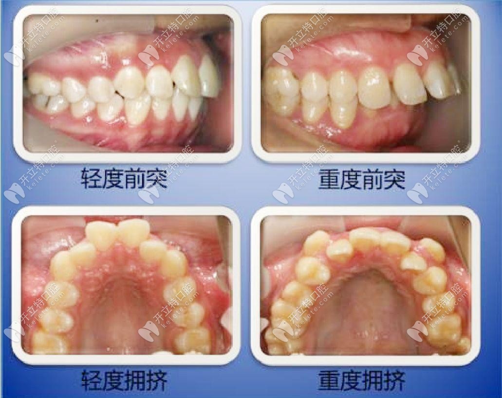 什么情況下需要拔牙才能矯正牙齒？