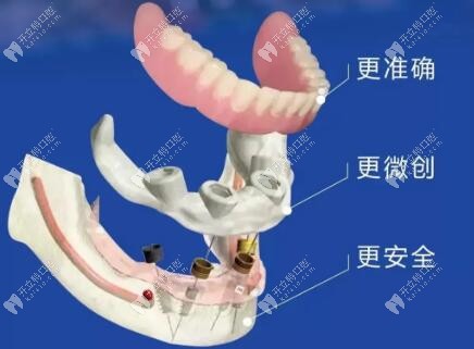?老話新談：中諾立得用種植牙好在哪兒？能用多久？