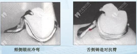 結(jié)合型卡環(huán)