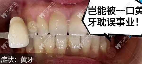 ?黃牙變白的牙醫(yī)忠告:做皓齒美白非但不后悔反而晉升啦