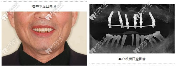 典型重度牙周炎種植案例:如何實(shí)現(xiàn)即刻種植與即刻修復(fù)？