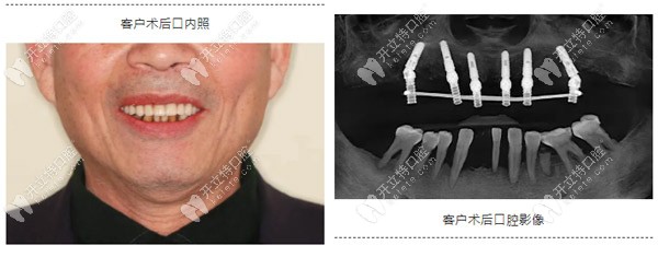 采用allon6即刻負重技術恢復了上半口牙