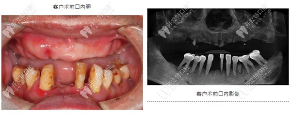 重度牙周炎導致上頜牙齒缺失