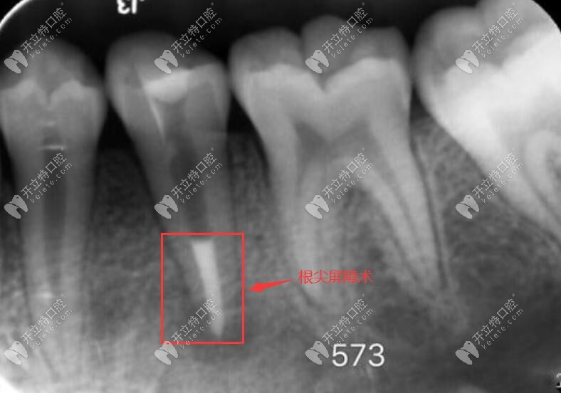 根尖屏障術(shù)的使用