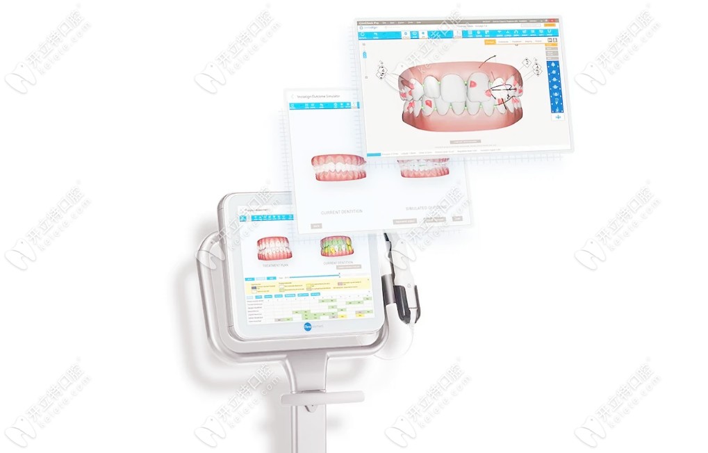 在嗎?帶你認識下iTero可視化口掃，可預(yù)見矯正效果的那種！