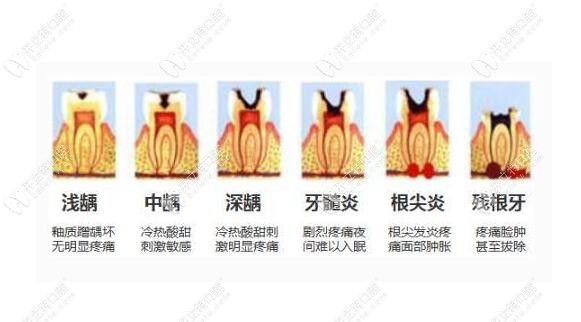 對于口腔材料:MTA與iroot的區(qū)別到底是什么,終于有答案了