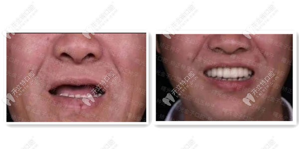 半口牙缺失種植前后圖