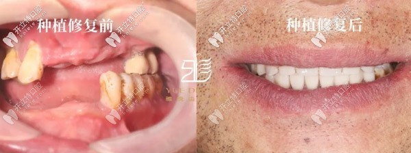 數(shù)字化種牙進行中:采用諾貝爾allon6+4全口負重技術