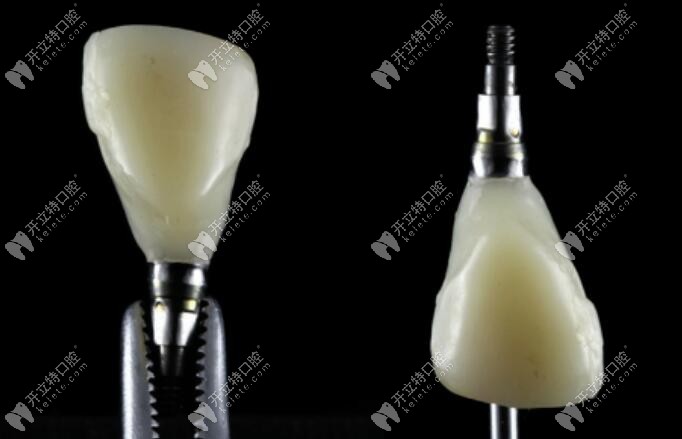 臨時(shí)牙冠的口外掃描