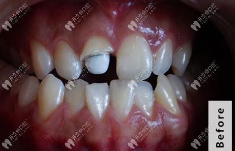 剛裝上纖維樁的牙齒外觀 剛裝上纖維樁的牙齒外觀