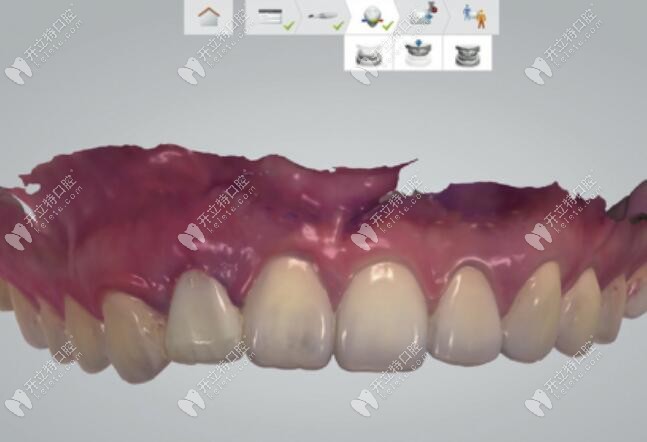 放入臨時(shí)牙冠使輪廓清晰