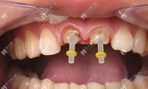 纖維樁的外觀 纖維樁的外觀