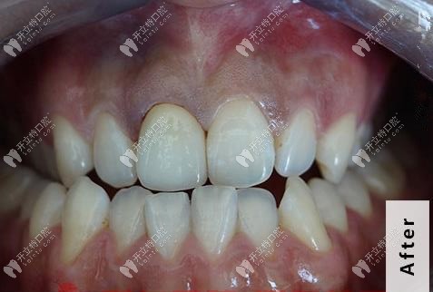 戴上全瓷冠后的牙齒形態(tài) 戴上全瓷冠后的牙齒形態(tài)