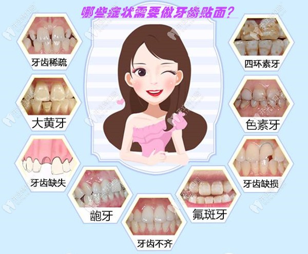 E-Max牙齒鑄瓷貼面適合人群