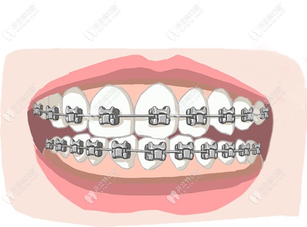 以色列科特斯種植牙的價(jià)格低到5100元起,就在福永河山口腔