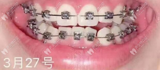 戴美國3M托槽矯正齙牙4個月的效果 戴美國3M托槽矯正齙牙4個月的效果