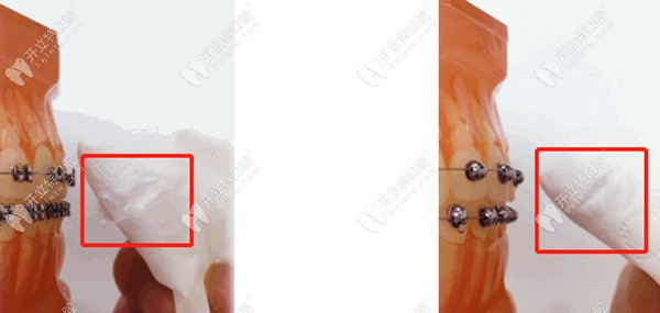 自鎖托槽中球面牙套好是方形牙套好，二者優(yōu)缺點(diǎn)先搞清哦