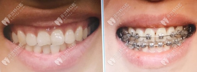 戴牙套前和戴牙套中