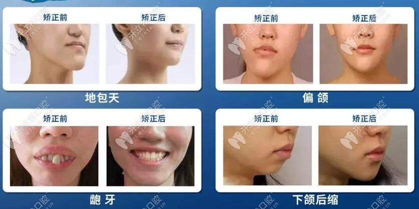 牙齒畸形的表現(xiàn)