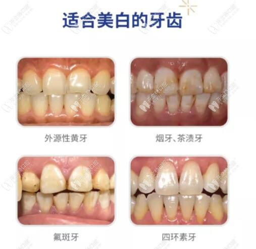 牙齒美白適應(yīng)癥