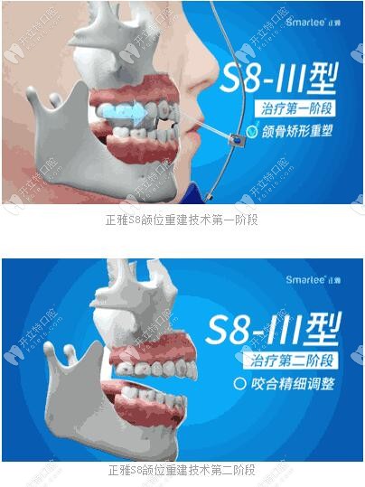 正雅S8、S9、S10頜位重建術(shù)