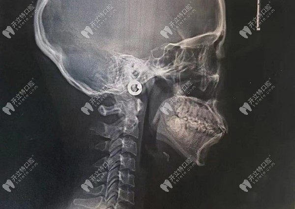 8月齙牙內收結果
