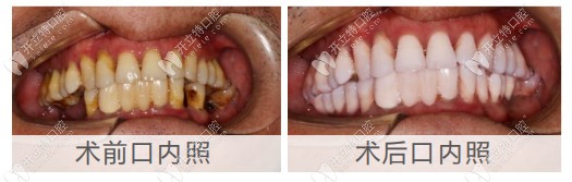 即刻種植牙手術前后對比