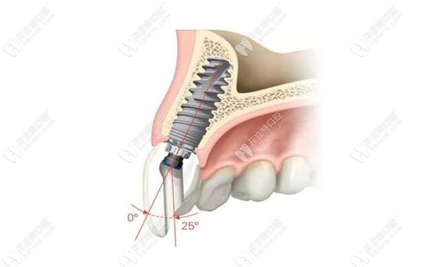 前牙種植修復(fù)技術(shù)