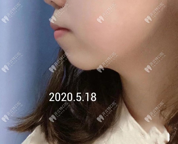 重慶華美口腔丁愛(ài)軍醫(yī)生矯正骨性齙牙嘴凸效果怎么樣？