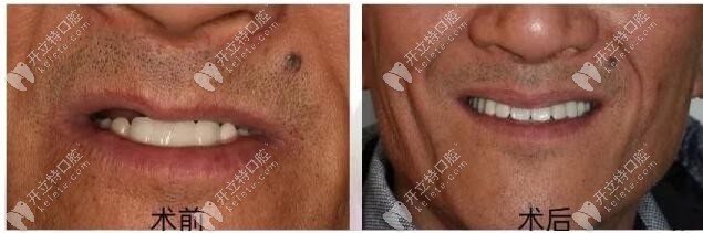 老人半口修復成功