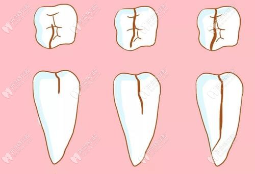 牙齒根折和縱裂的對比圖
