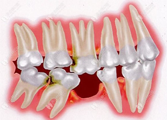 缺一顆牙后的連鎖反應(yīng)