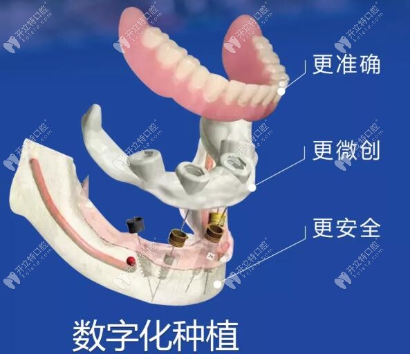 3D數(shù)字化種植