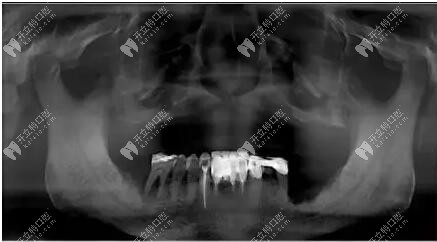 拍片檢查上頜位置
