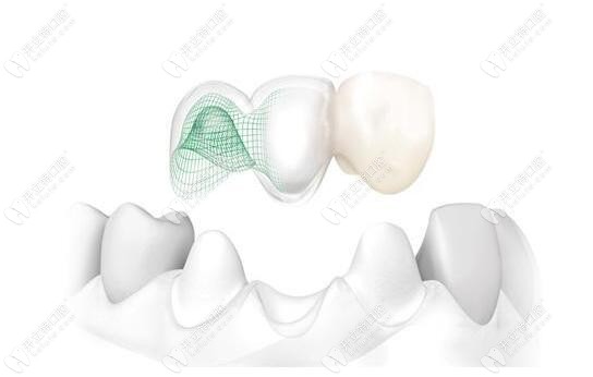 固定假牙修復(fù)圖示 固定假牙修復(fù)圖示