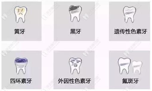 適合做皓齒美白的牙齒情況 適合做皓齒美白的牙齒情況