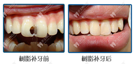 樹脂補(bǔ)牙前后對比