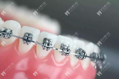 牙齒矯正示意圖 牙齒矯正示意圖