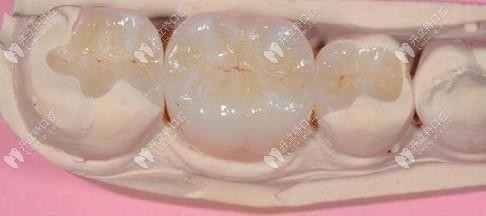 樹脂補牙外觀圖 樹脂補牙外觀圖