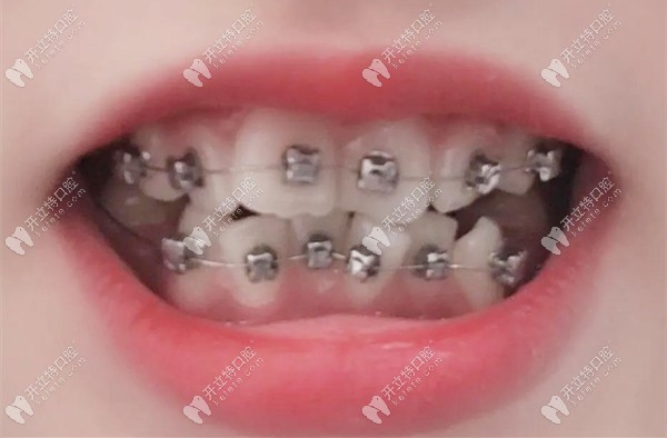 戴金屬自鎖托槽牙套做矯治