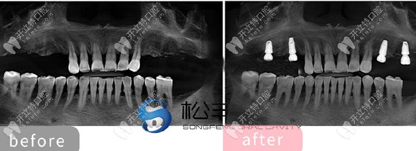 多顆牙齒缺失種植展示