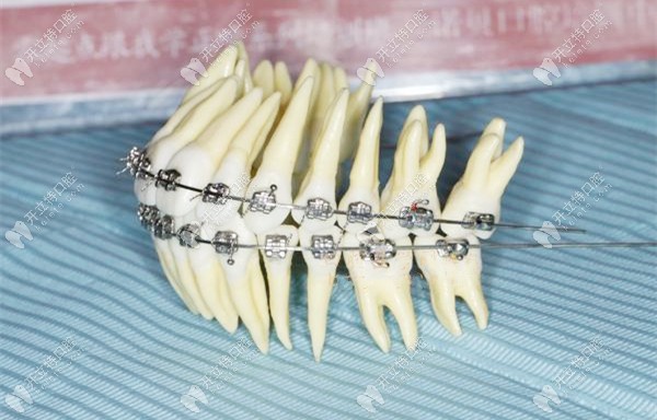 直絲弓傳動矯正