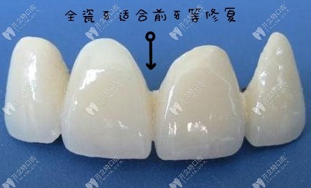 前牙等修復(fù)推薦全瓷牙