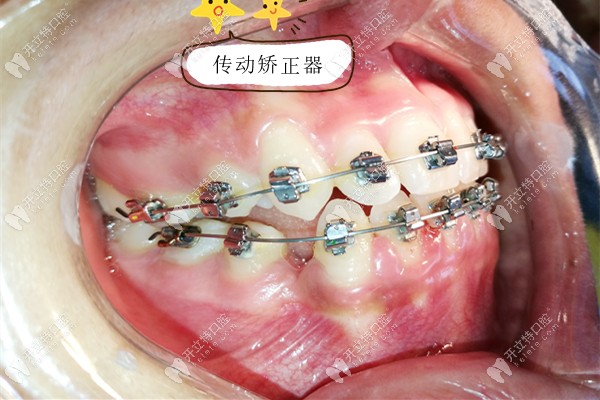 傳動矯正器在口內(nèi)的展示圖