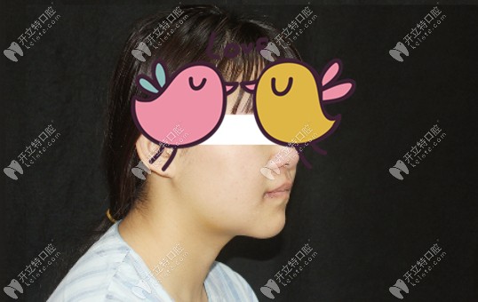 骨性地包天做正頜后的臉型改變<span style=