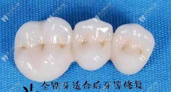 全鋯牙適合做后牙等修復(fù)