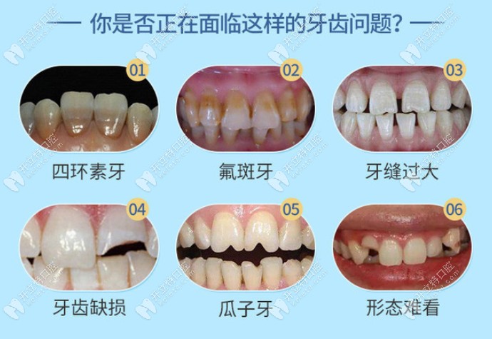 納米美牙貼面的適應(yīng)癥